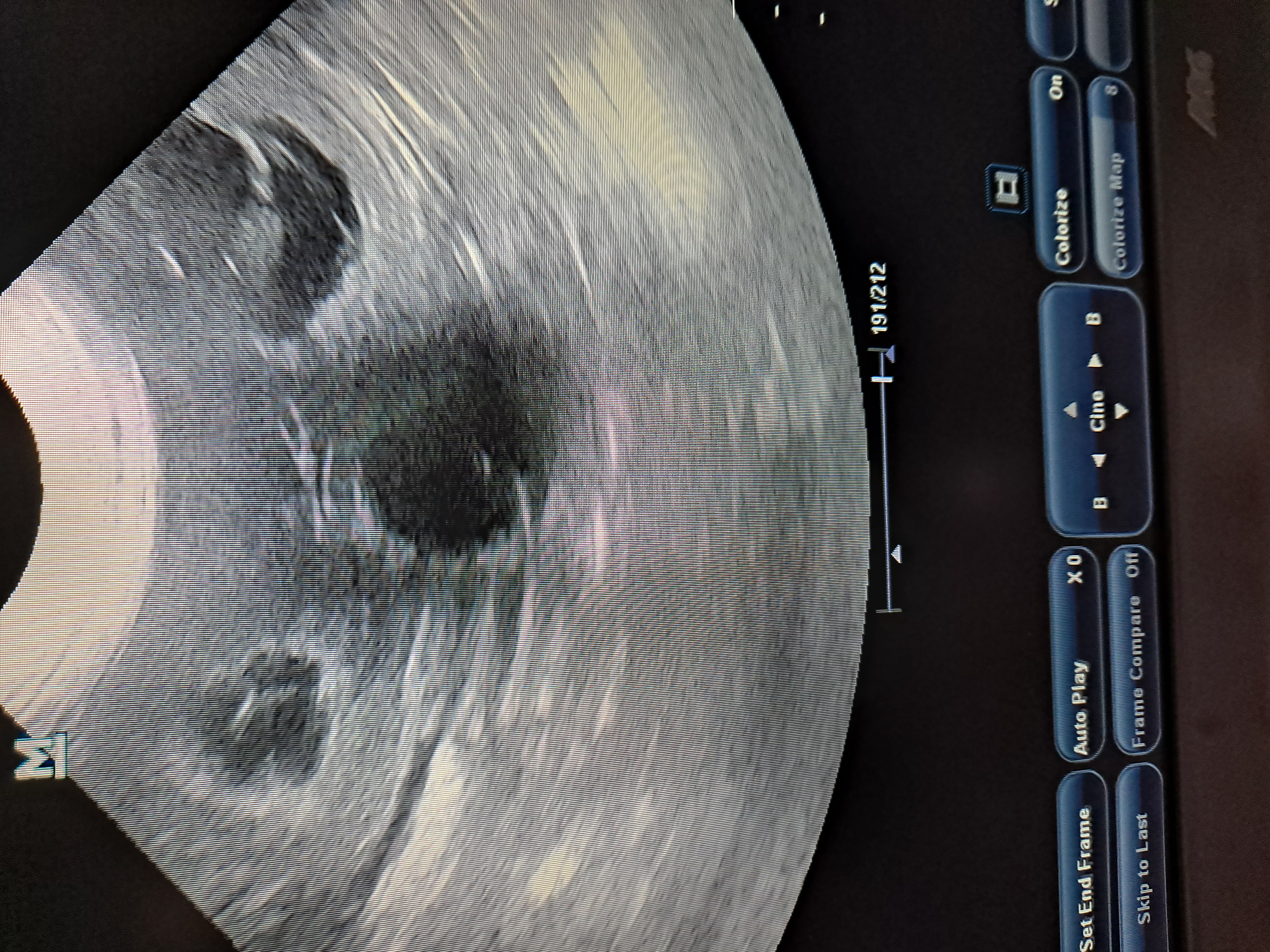 Ultrasound photo